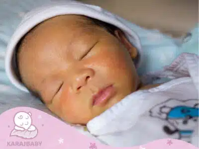 درمان زردی نوزاد با طب سنتی